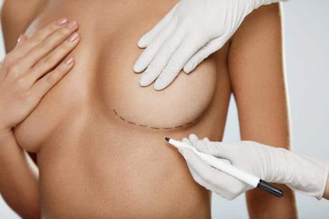 Breast Implant Removal in Mesa, AZ
