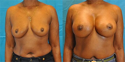 Breast Augmentation Patient in Scottsdale, AZ