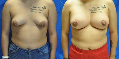 Breast Implant Patient in Scottsdale, AZ