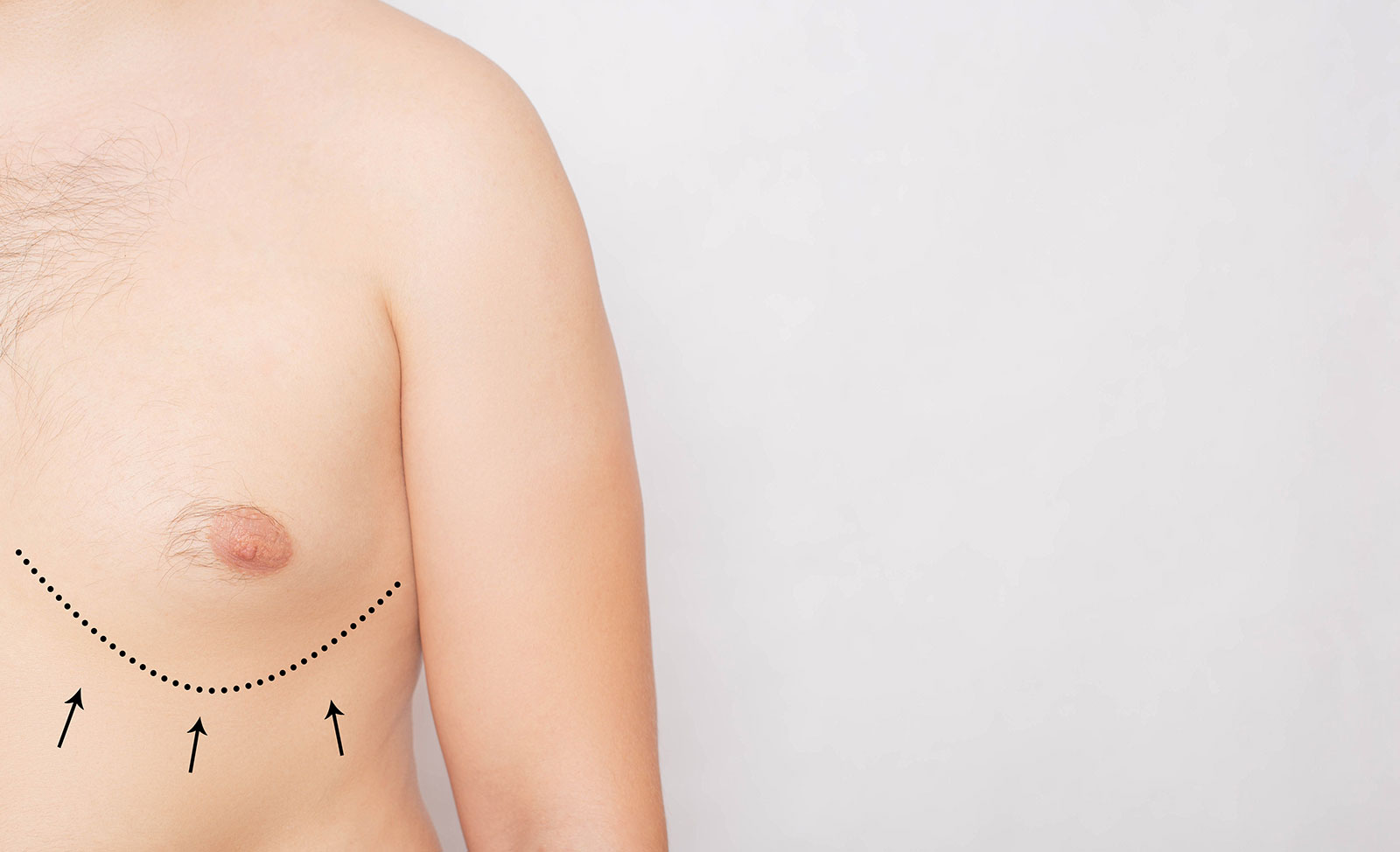 Surgical marking lines drawn on a man chest